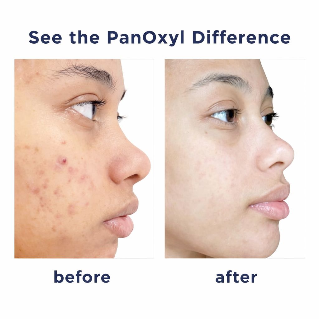 PanOxyl Acne Face Wash