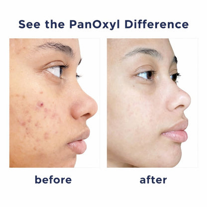 PanOxyl Acne Face Wash